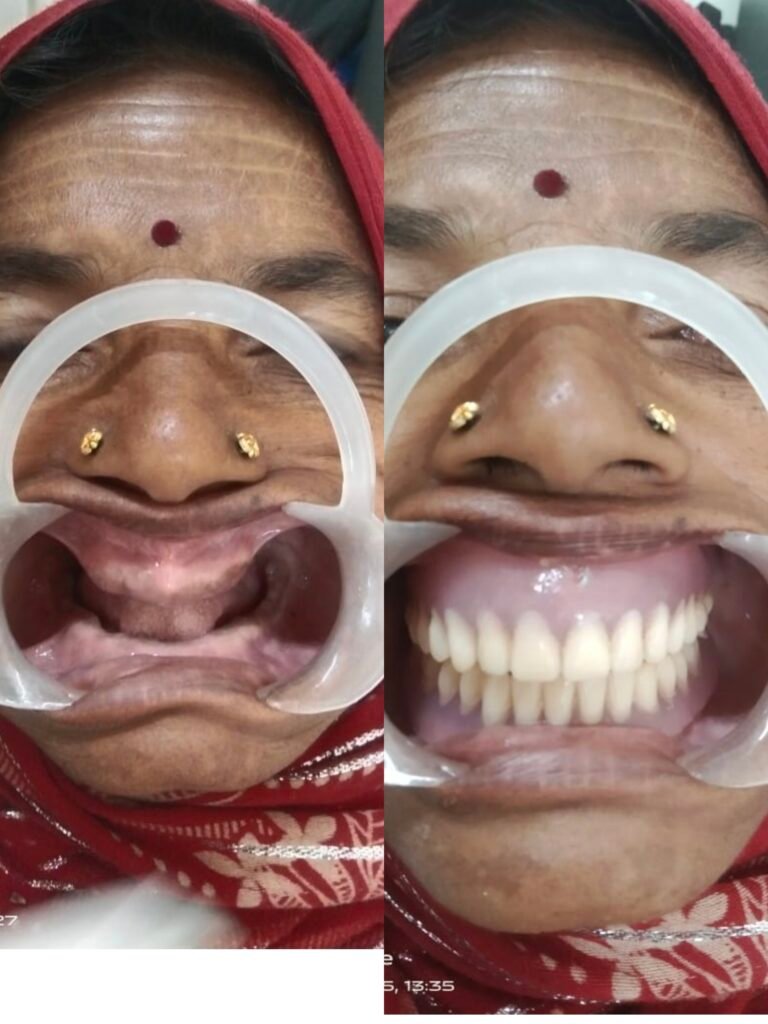 KORBA:-सामुदायिक स्वा.केन्द्र कटघोरा में कृत्रिम दांत लगवाने की सुविधा