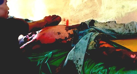 KORßA:-हाई वोल्टेज तार की चपेट में आया मजदूर झुलसा, हालत गंभीर